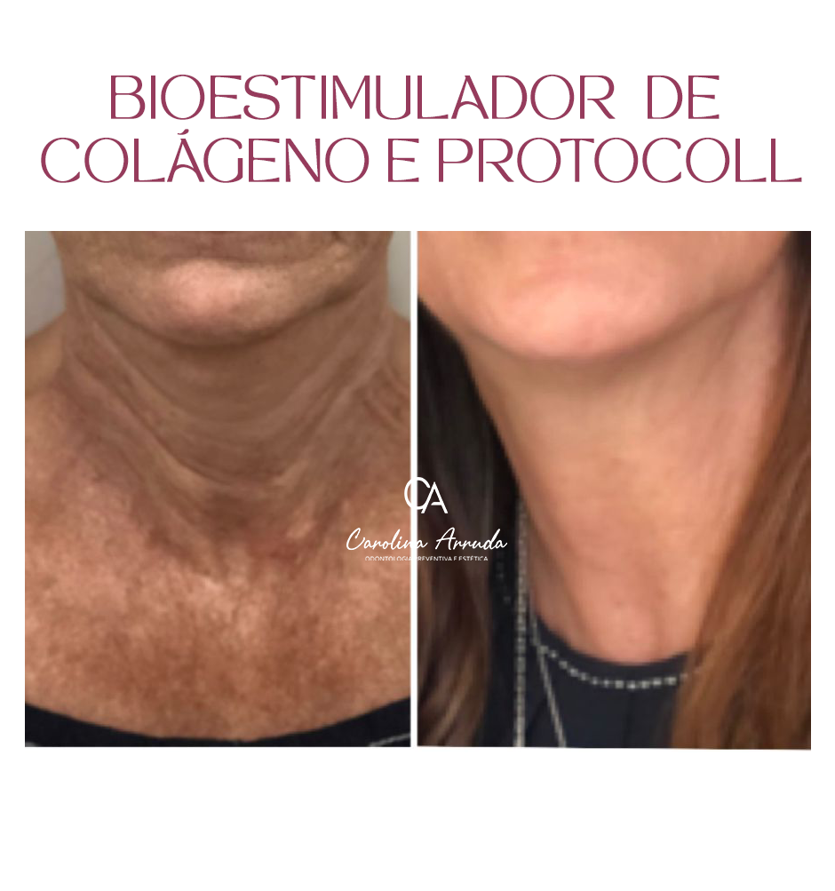 BIOESTIMULADOR DE COLÁGEN