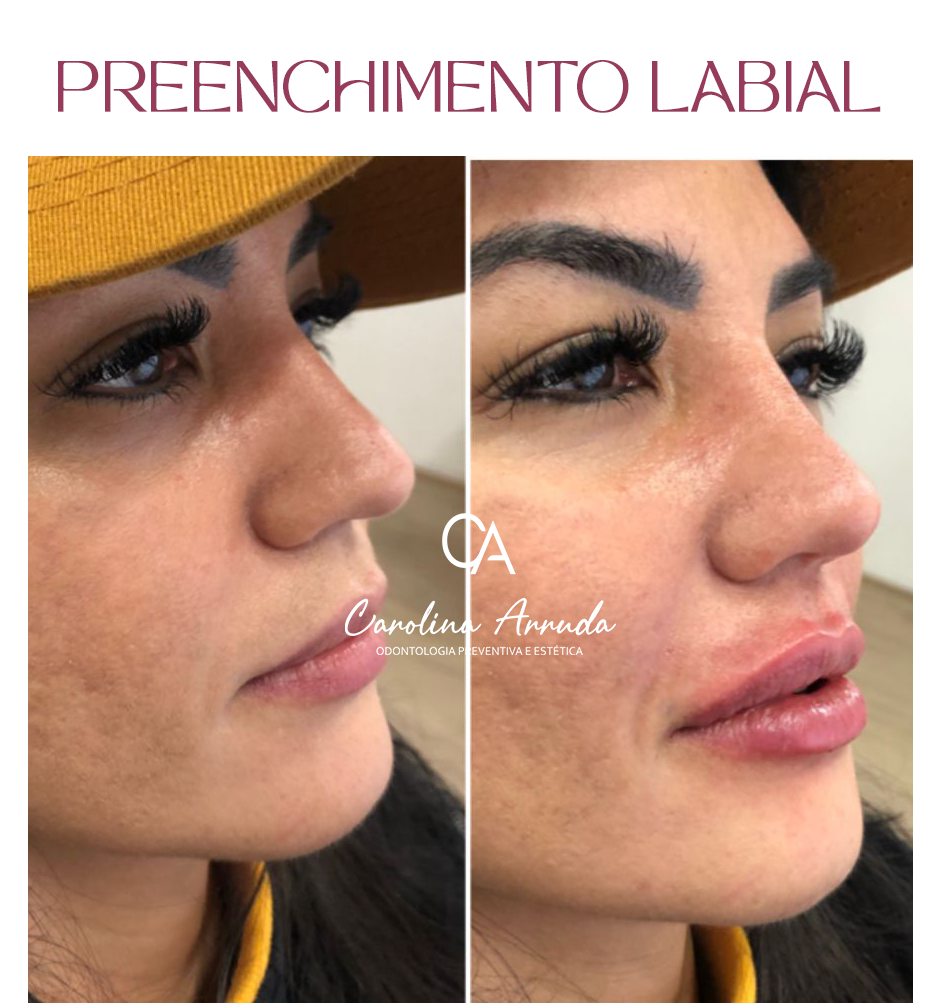 PREENCHIMENTO LABIAL