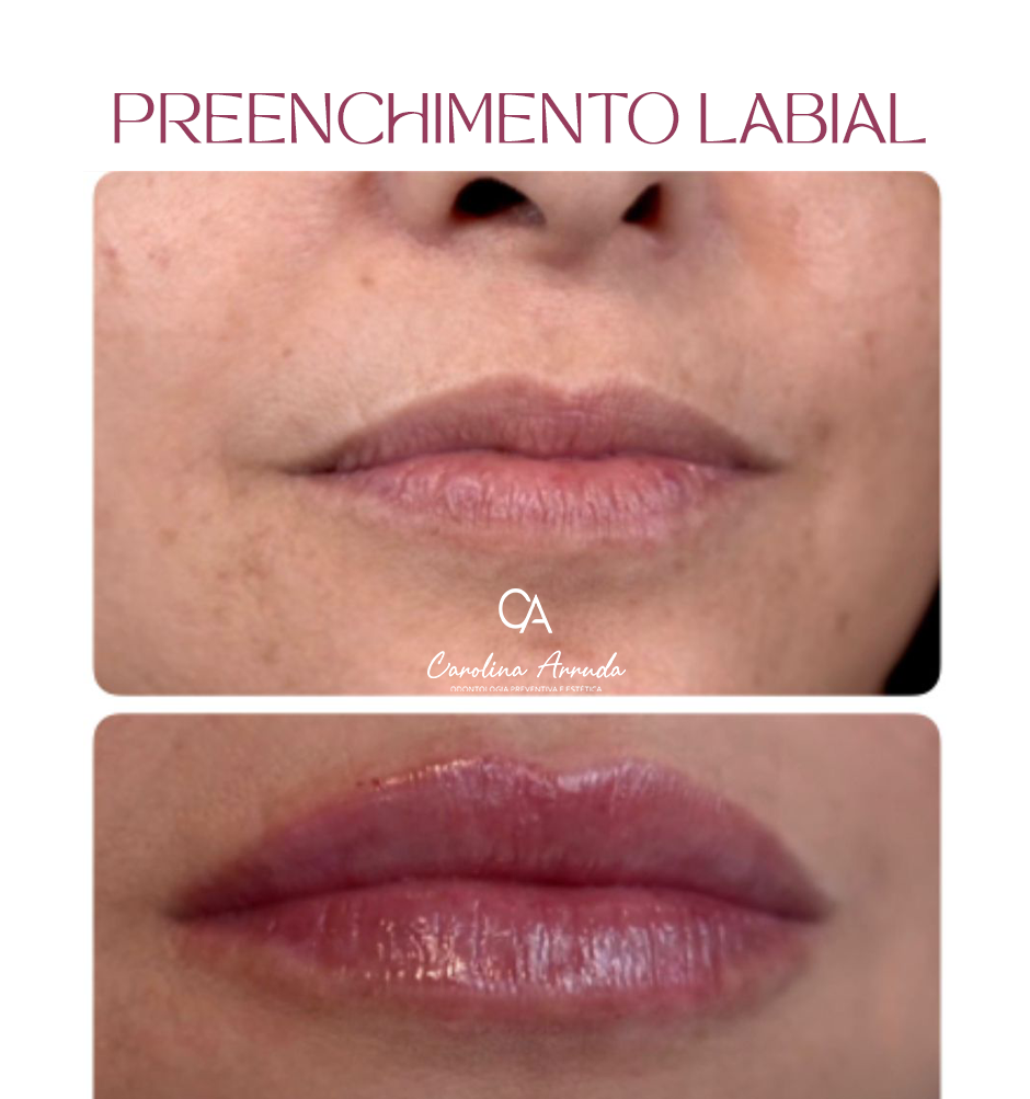 PRENCHIMENTO LABIAL 02
